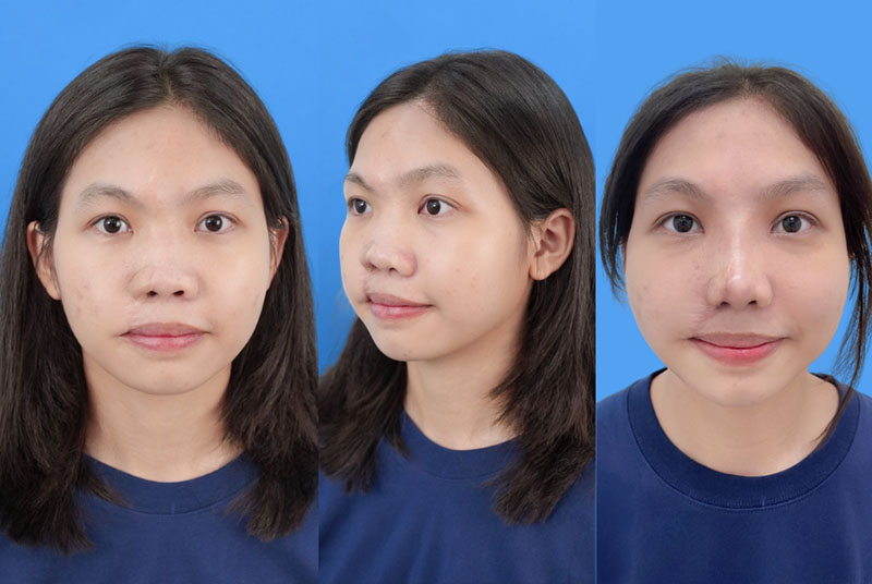 Hình ảnh mới nhất của Thiên Cát sau 3 thì phẫu thuật