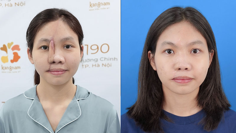 Sau mỗi thì phẫu thuật, chiếc mũi của Thiên Cát lại được hoàn thiện hơn