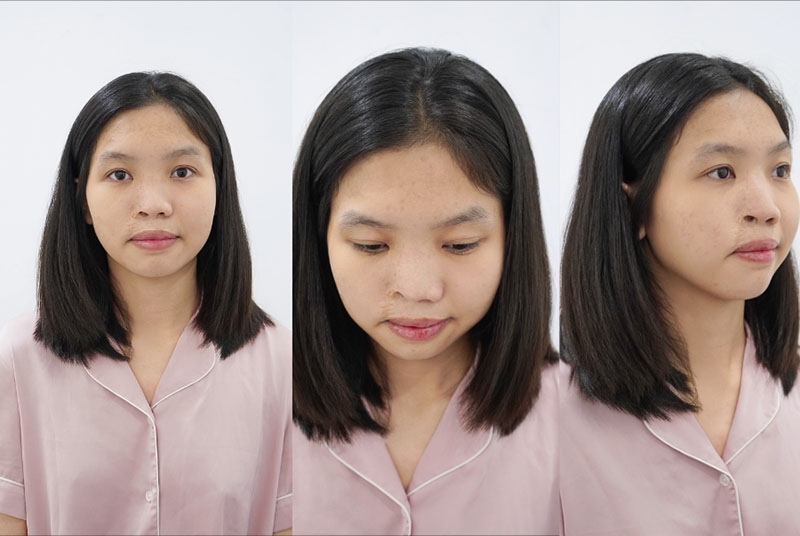 Tình trạng mũi của Thiên Cát trước khi phẫu thuật tại BV Thẩm mỹ Kangnam