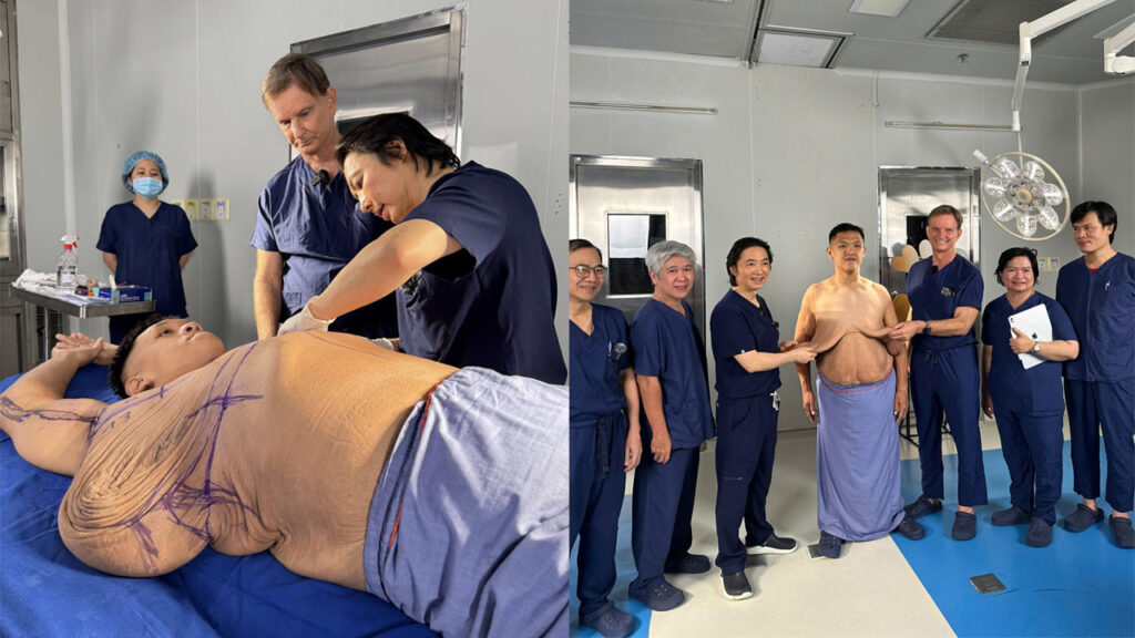 Trọng Nhân Bye Béo tiếp tục loại bỏ 6kg da thừa vùng lưng + ngực