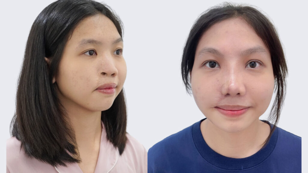 Tái tạo mũi cho bé Thiên Cát: Bước đi đầu tiên quyết định toàn bộ hành trình