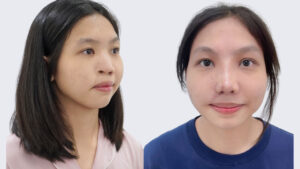 Tái tạo mũi cho bé Thiên Cát: Bước đi đầu tiên quyết định toàn bộ hành trình