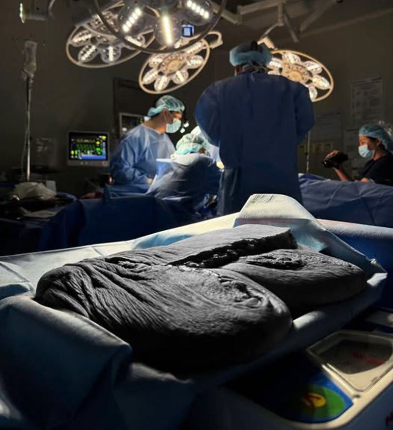 Khối da thừa “khổng lồ” đã loại bỏ của Trọng Nhân