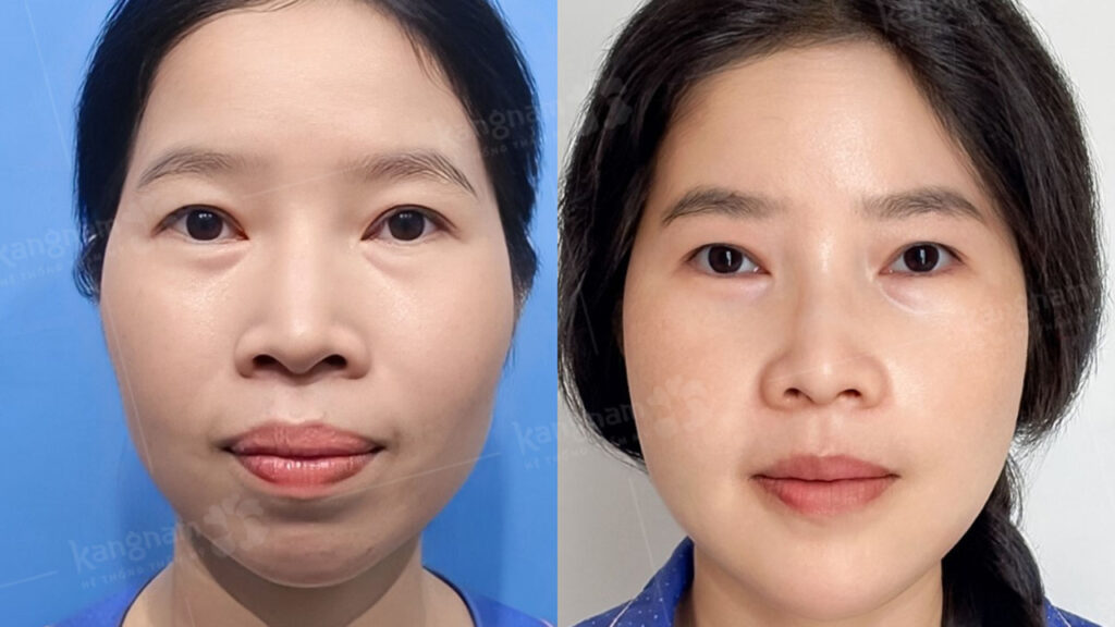 Chỉnh hình hàm mặt là gì? Trường hợp cần thực hiện, lợi ích và rủi ro