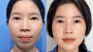 Chỉnh hình hàm mặt là gì? Trường hợp cần thực hiện, lợi ích và rủi ro