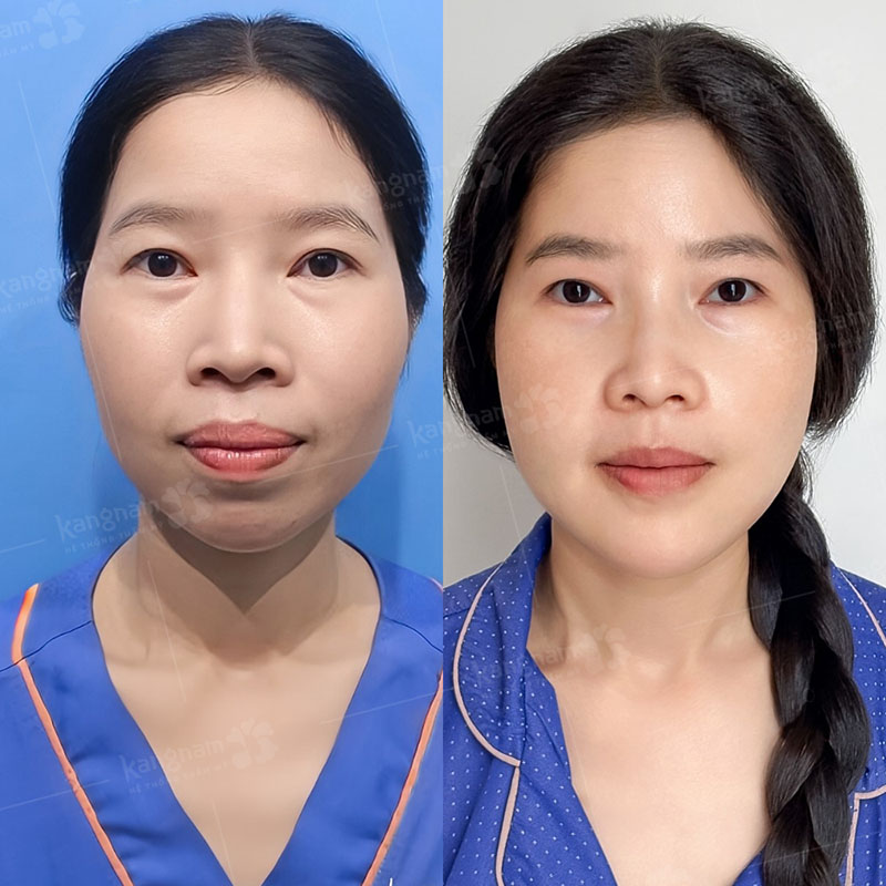 Chỉnh hàm giúp khách trẻ trung hơn