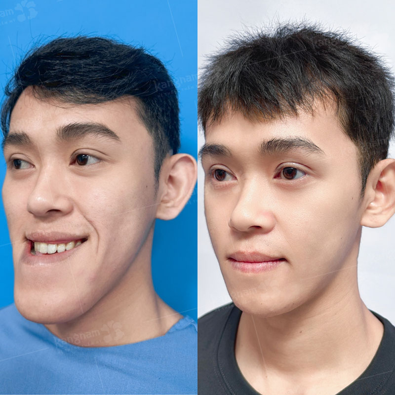 Chỉnh hình hàm mặt không chỉ “lột xác” mà còn cải thiện chức năng ăn nhai, giao tiếp