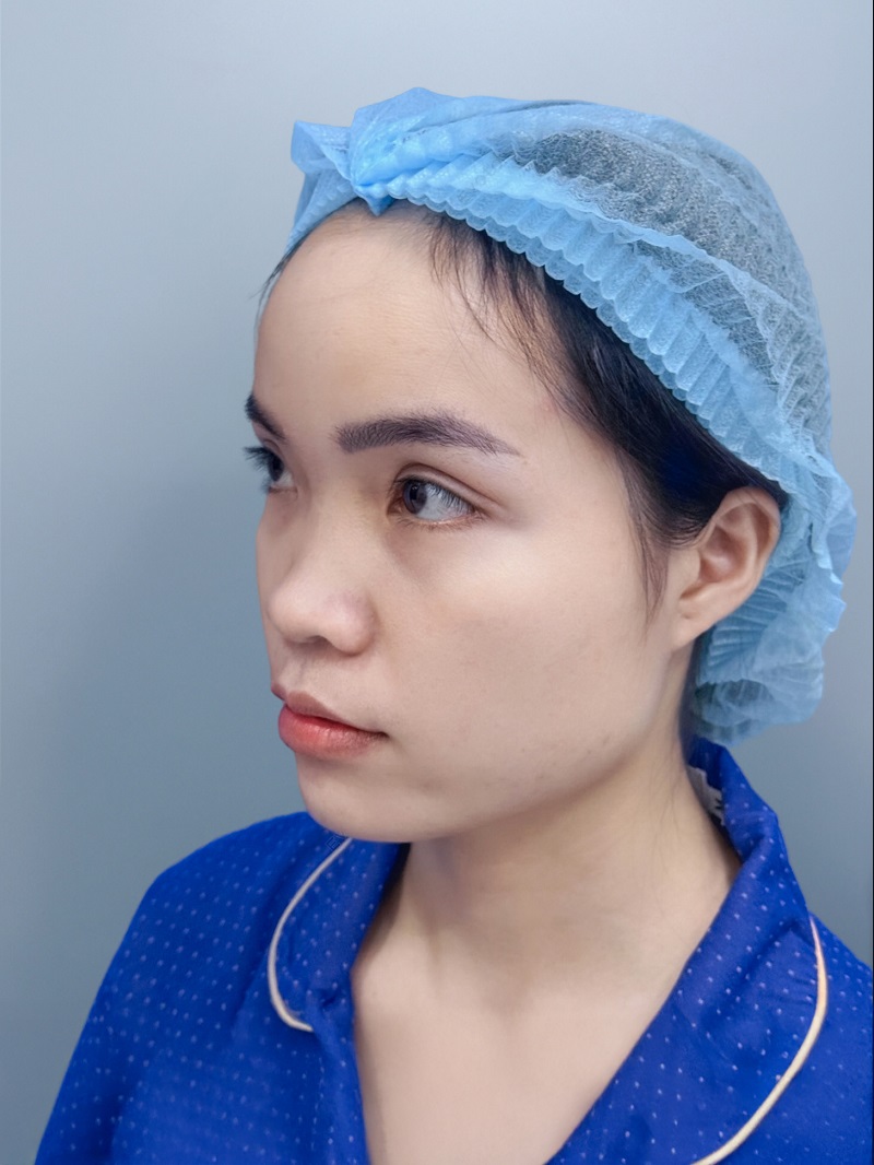 Kim Hạnh gặp tình trạng sống mũi thấp, cánh mũi bè