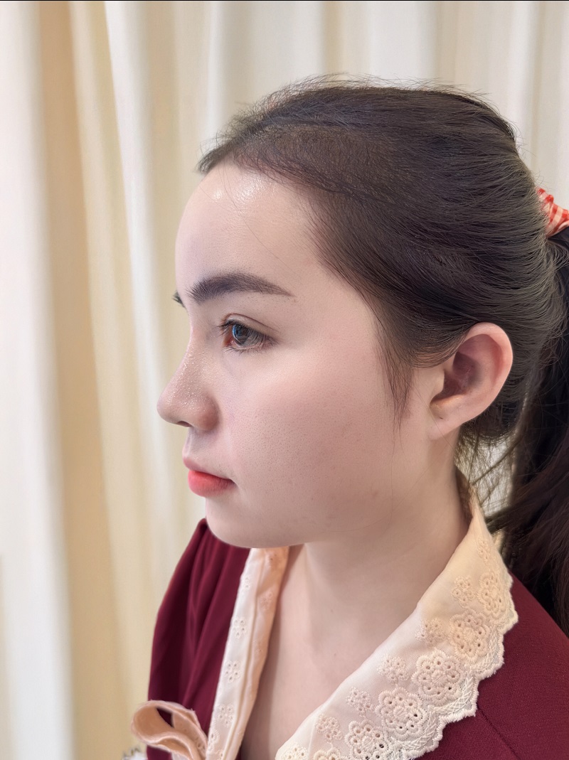 Kết quả sau 7 ngày nâng mũi, dáng mũi tự nhiên và hài hòa