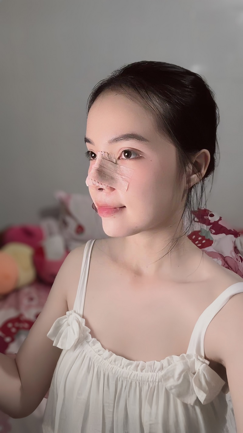 Hình ảnh Kim Hạnh sau nâng mũi 5 ngày