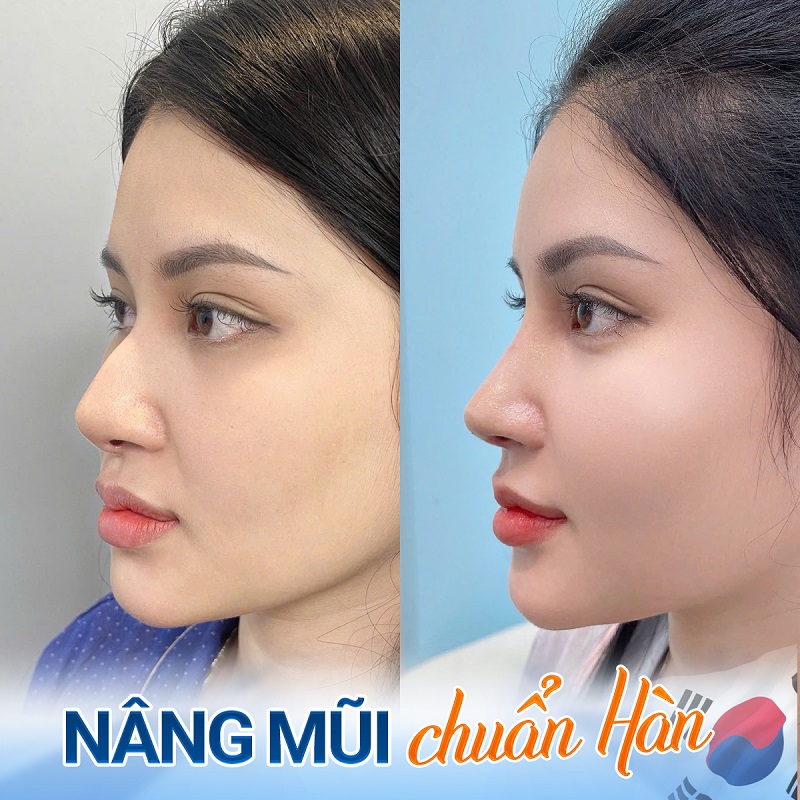10 ngày sau nâng mũi, dáng mũi cân đối khắc phục mũi lệch