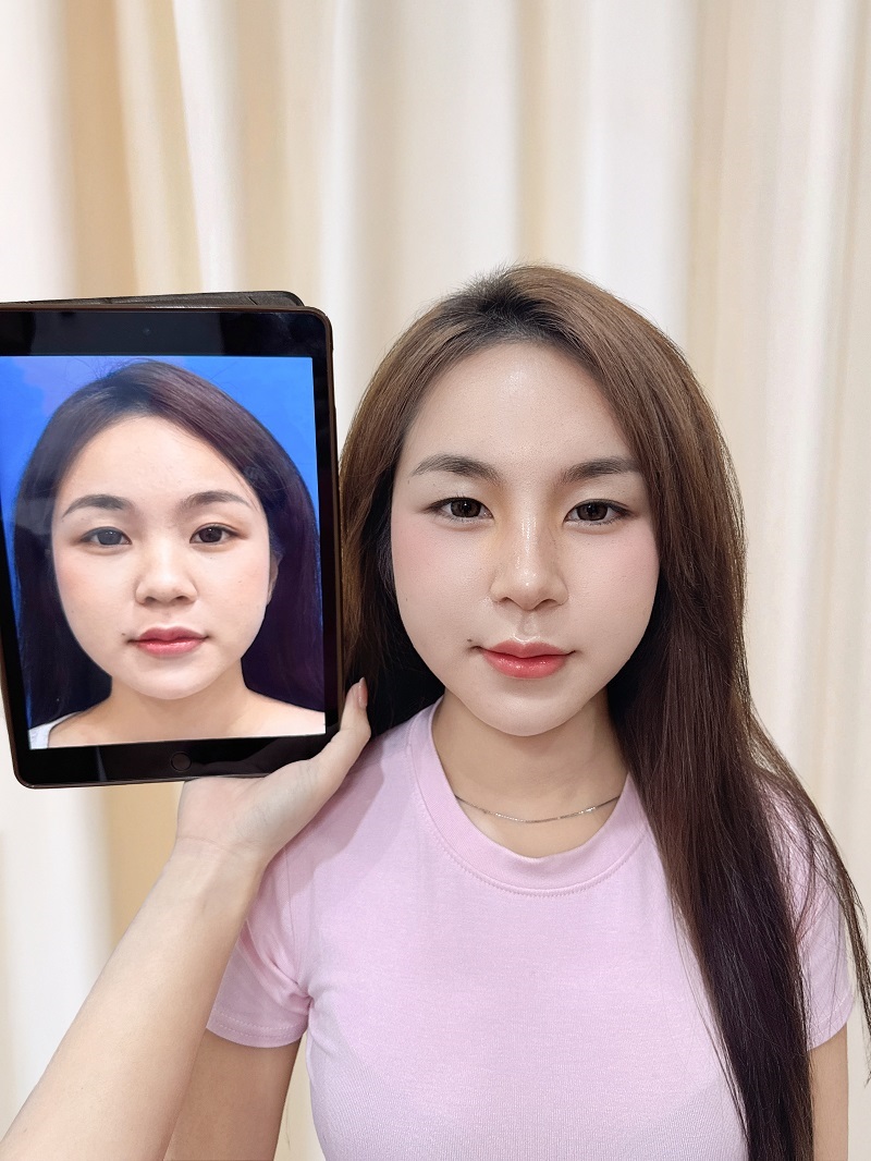 Gia Ân gặp tình trạng mũi thấp, đầu mũi to