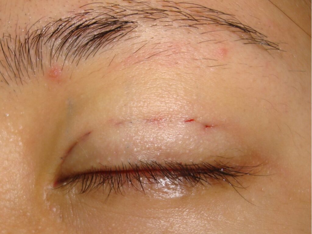 Sẹo nhấn mí do thực hiện sai kỹ thuật