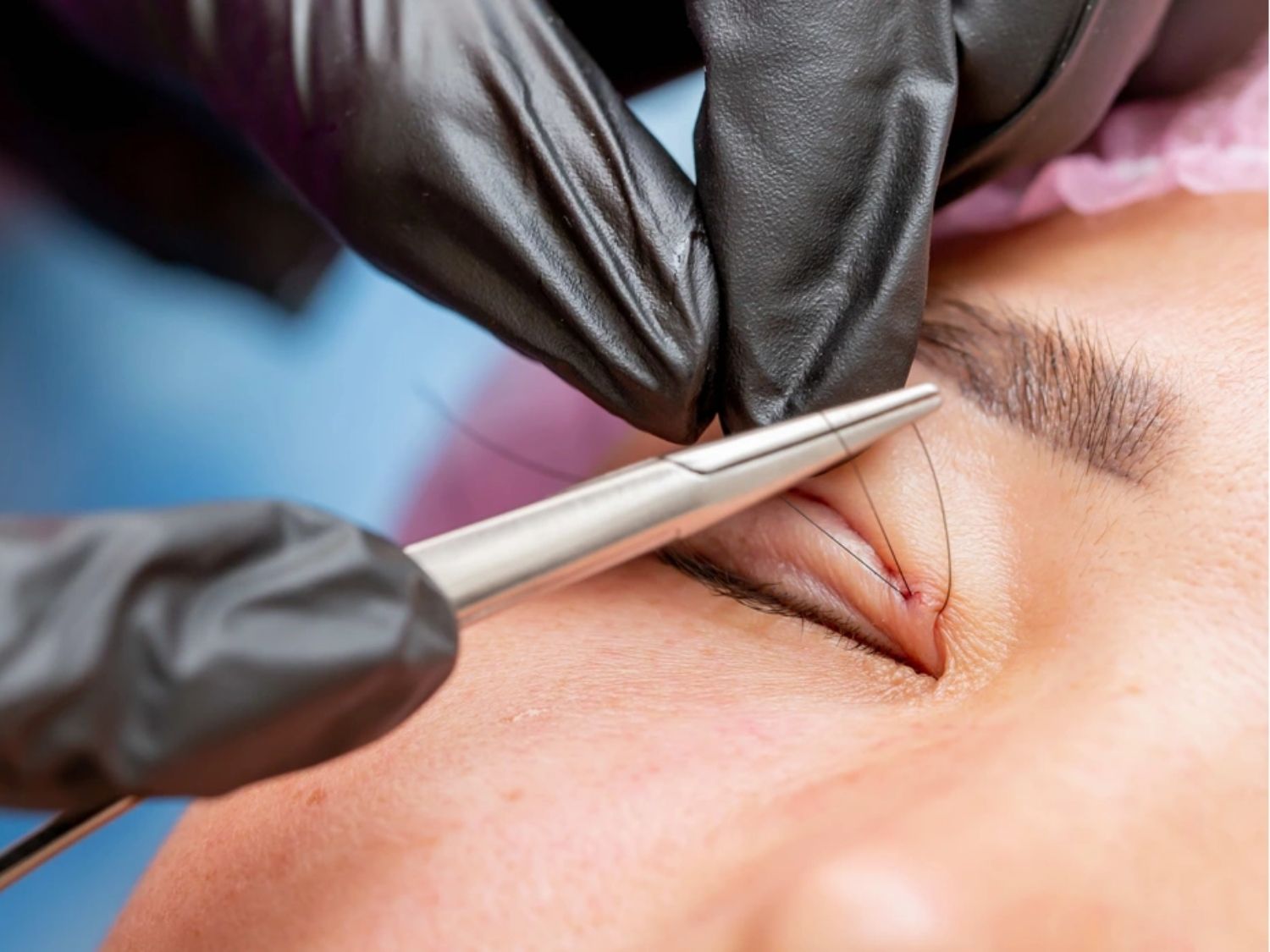 Cắt mí để lại sẹo do phải thực hiện đường cắt để tạo nếp mí mới