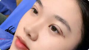 Cắt mí giữ được bao lâu