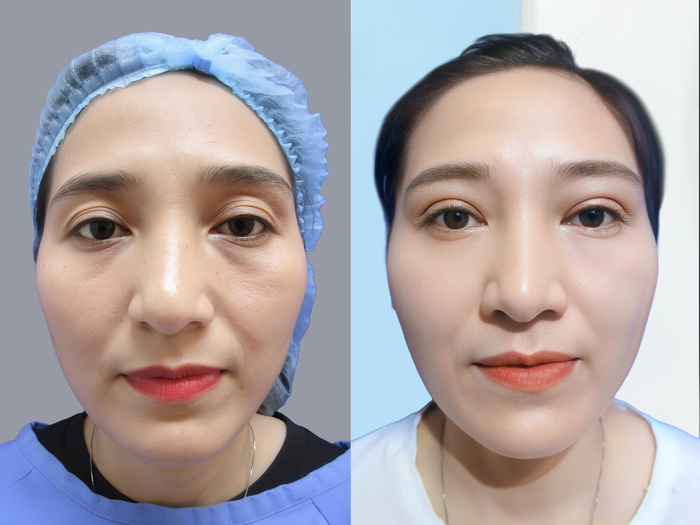 Cấy mỡ kết hợp cắt mí