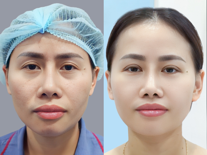 Cắt mí trẻ hóa vùng mắt