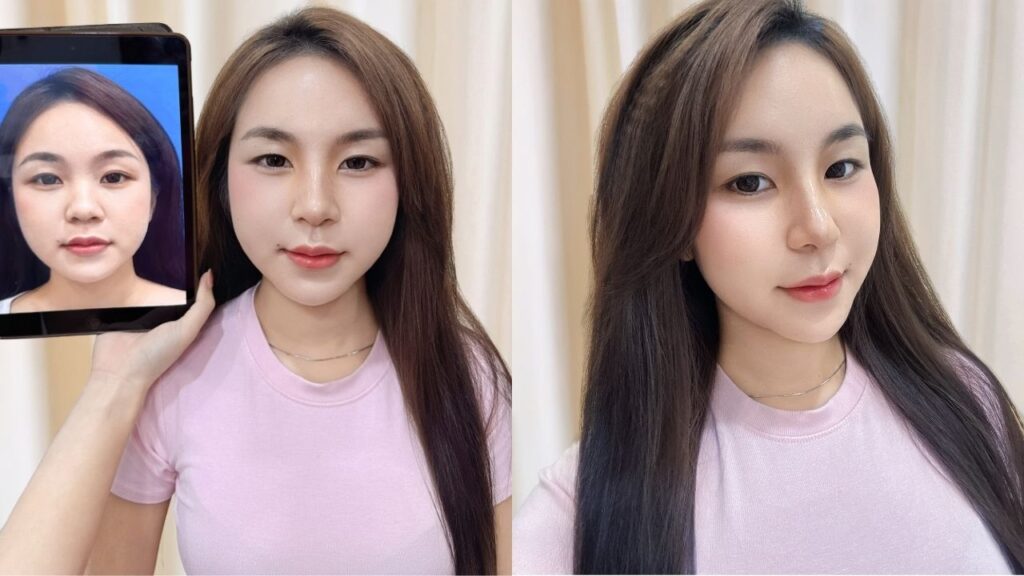 Gia Ân “thăng hạng nhan sắc” ngoạn mục sau nâng mũi tại Kangnam Sài Gòn