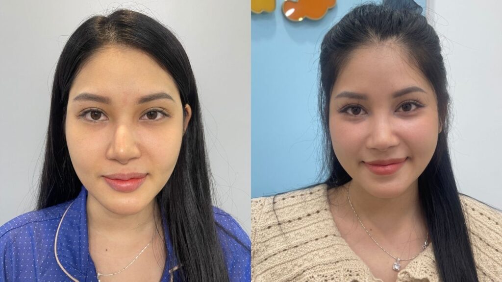 Hành trình sửa mũi tái sinh diện mạo cho Hương Ly tại Kangnam Hà Nội