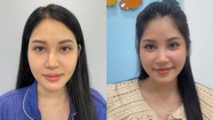 Hành trình sửa mũi tái sinh diện mạo cho Hương Ly tại Kangnam Hà Nội
