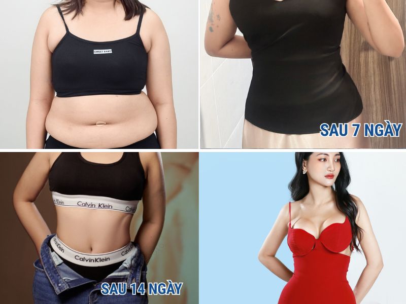 Các giai đoạn hồi phục sau hút mỡ từ sưng đau tới cơ thể hoàn hảo cân đối vòng 2 chữ S