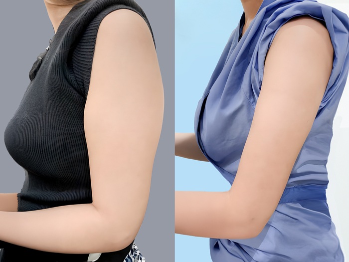 Hút mỡ bắp tay có thời gian hồi phục nhanh chóng, giúp bắp tay thon gọn, săn chắc 