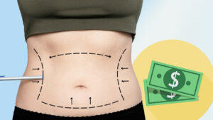 iá hút mỡ bụng 2026 bao nhiêu tiền? Bảng giá trọn gói tại Bệnh viện thẩm mỹ uy tín