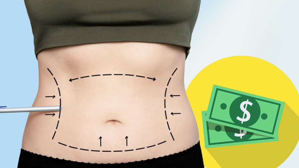 Hút mỡ bụng giá bao nhiêu tiền? Bảng giá mới nhất