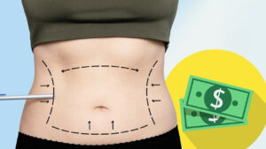 Hút mỡ bụng giá bao nhiêu tiền? Bảng giá mới nhất