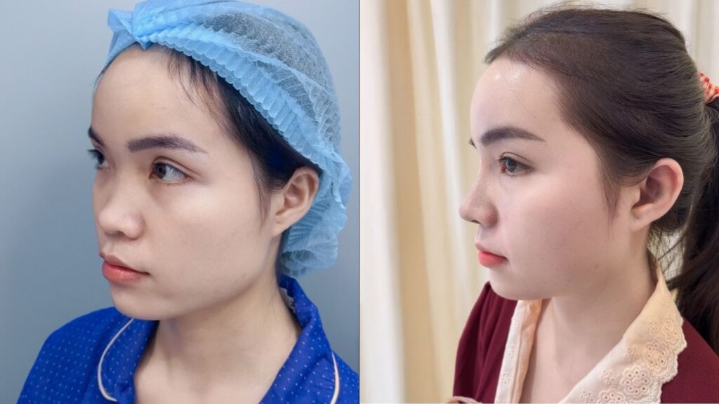 Kim Hạnh “lột xác” diện mạo sau nâng mũi tại Kangnam Sài Gòn