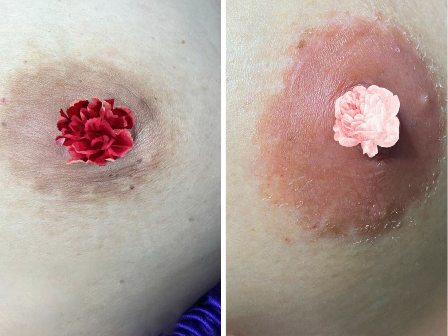 Nhũ hoa màu sắc tươi tắn, hồng hào