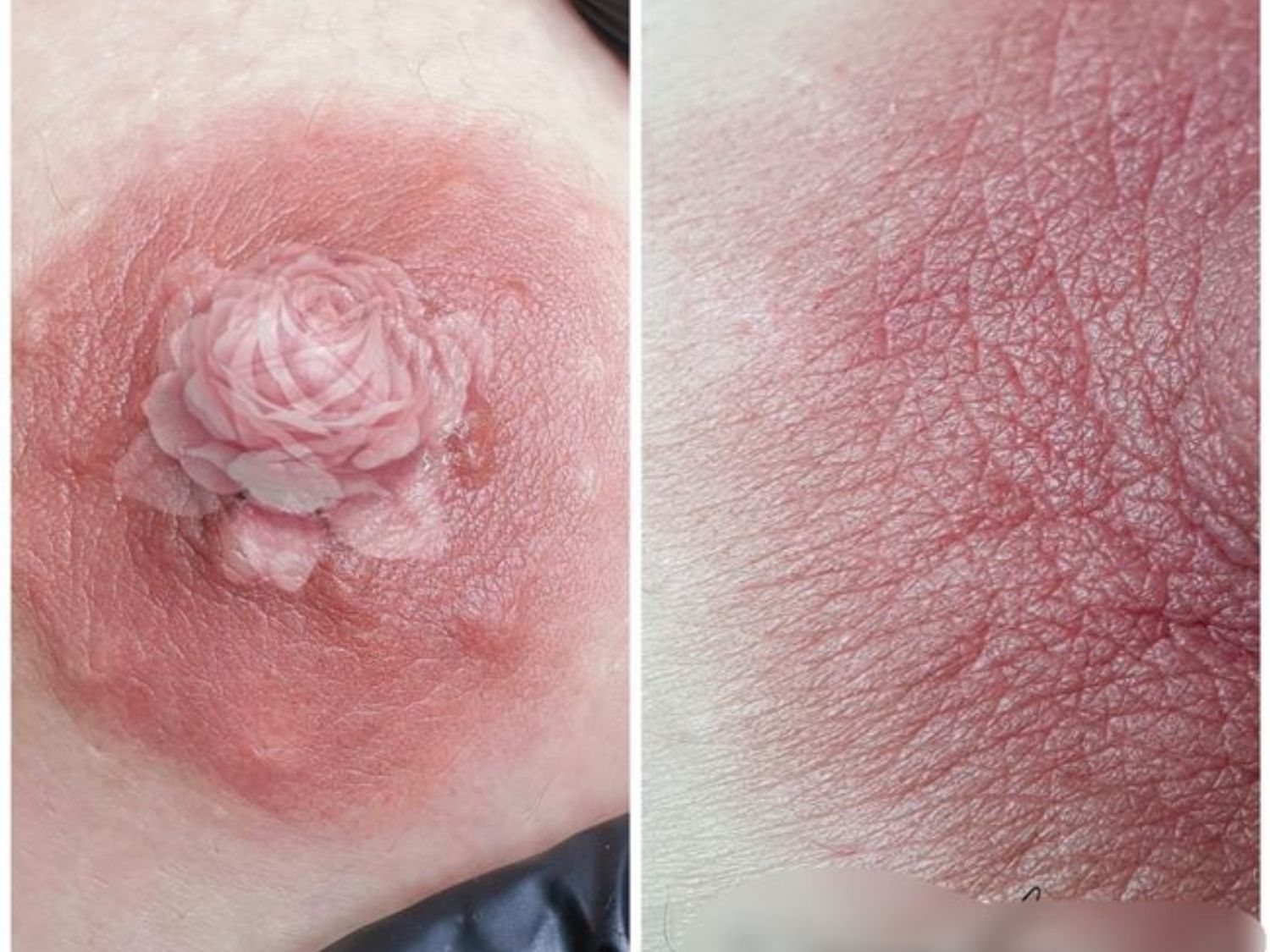 Loại bỏ hoàn toàn các khuyết điểm trên nhũ hoa