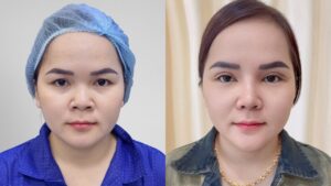 Màn “lột xác” ấn tượng của Như Ý sau cắt mí và nâng mũi tại Kangnam Sài Gòn