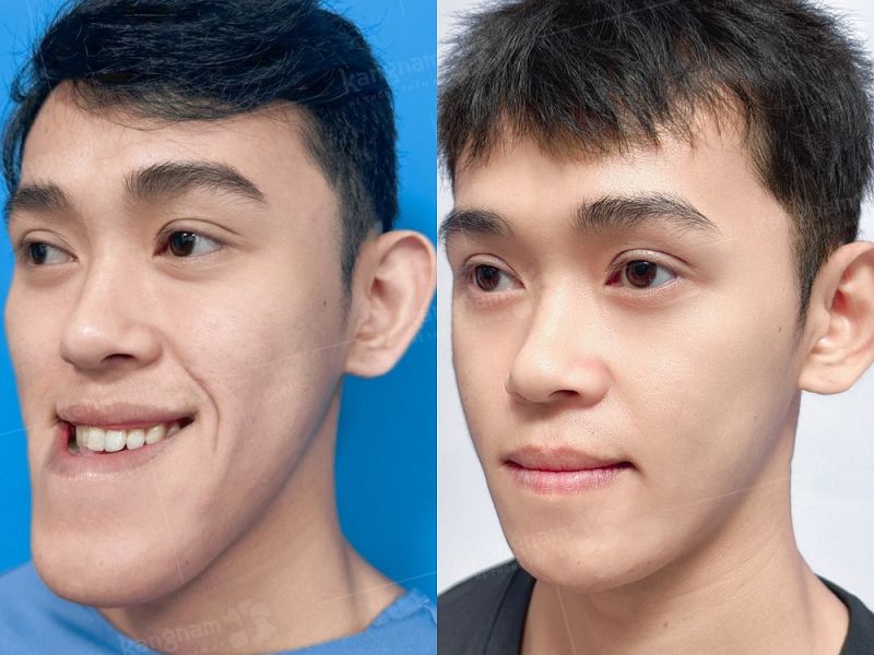 Sở hữu gương mặt cân đối khắc phục tình trạng hàm hô, móm, lẹm bằng dịch vụ chỉnh hàm 