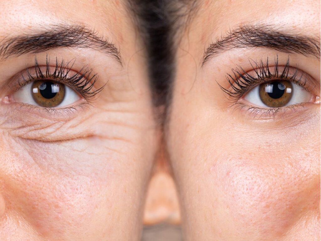 Xóa nhăn vùng mắt giá bao nhiêu? Chi phí theo từng phương pháp & lưu ý