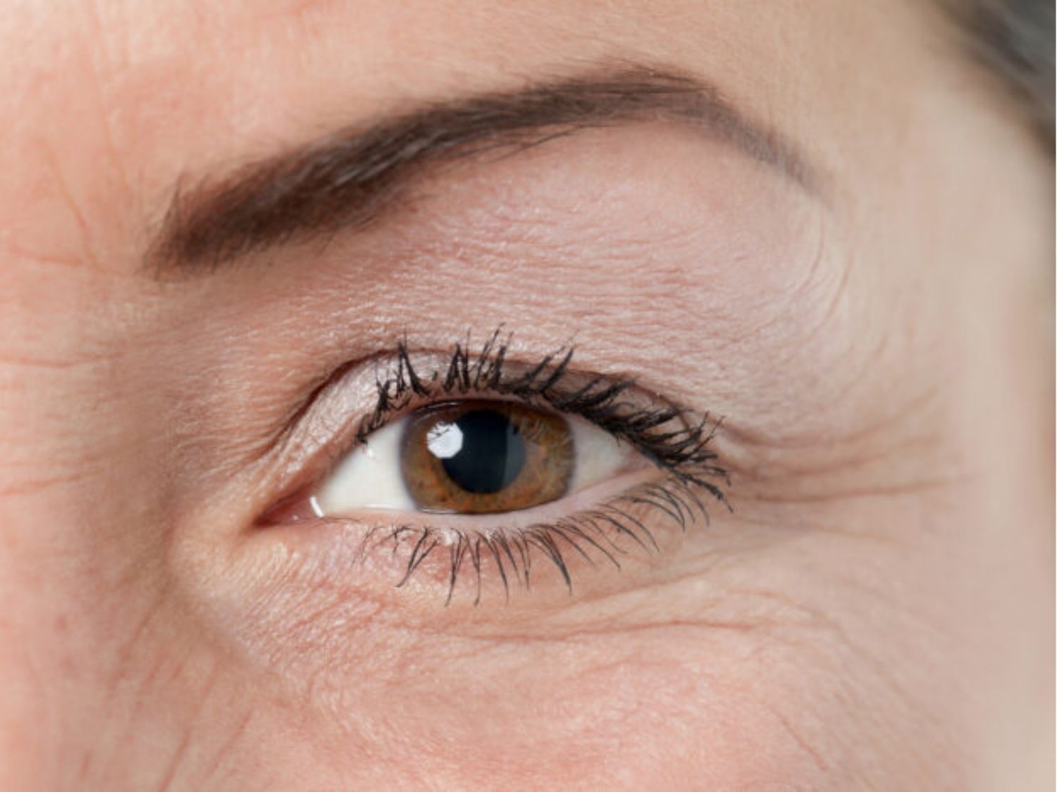 Nếp nhăn sâu tốn nhiều chi phí hơn