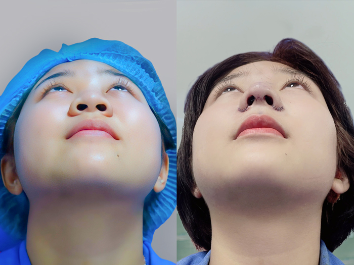 Quy trình cắt cánh mũi an toàn, kết quả sau khi vừa thực hiện