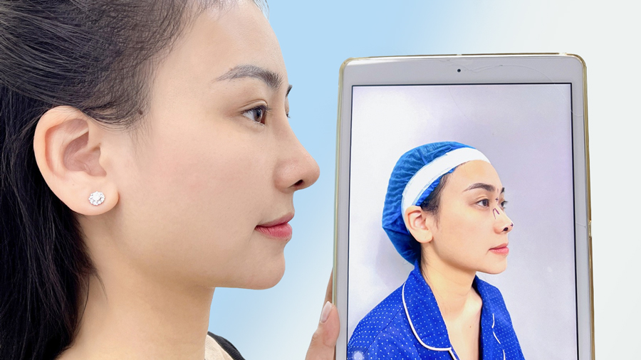 Nâng mũi Surgiform giá bao nhiêu? Bảng giá mới nhất