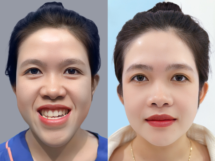 Khách hàng chỉnh hàm móm tại Kangnam sở hữu khuôn hàm cân đối