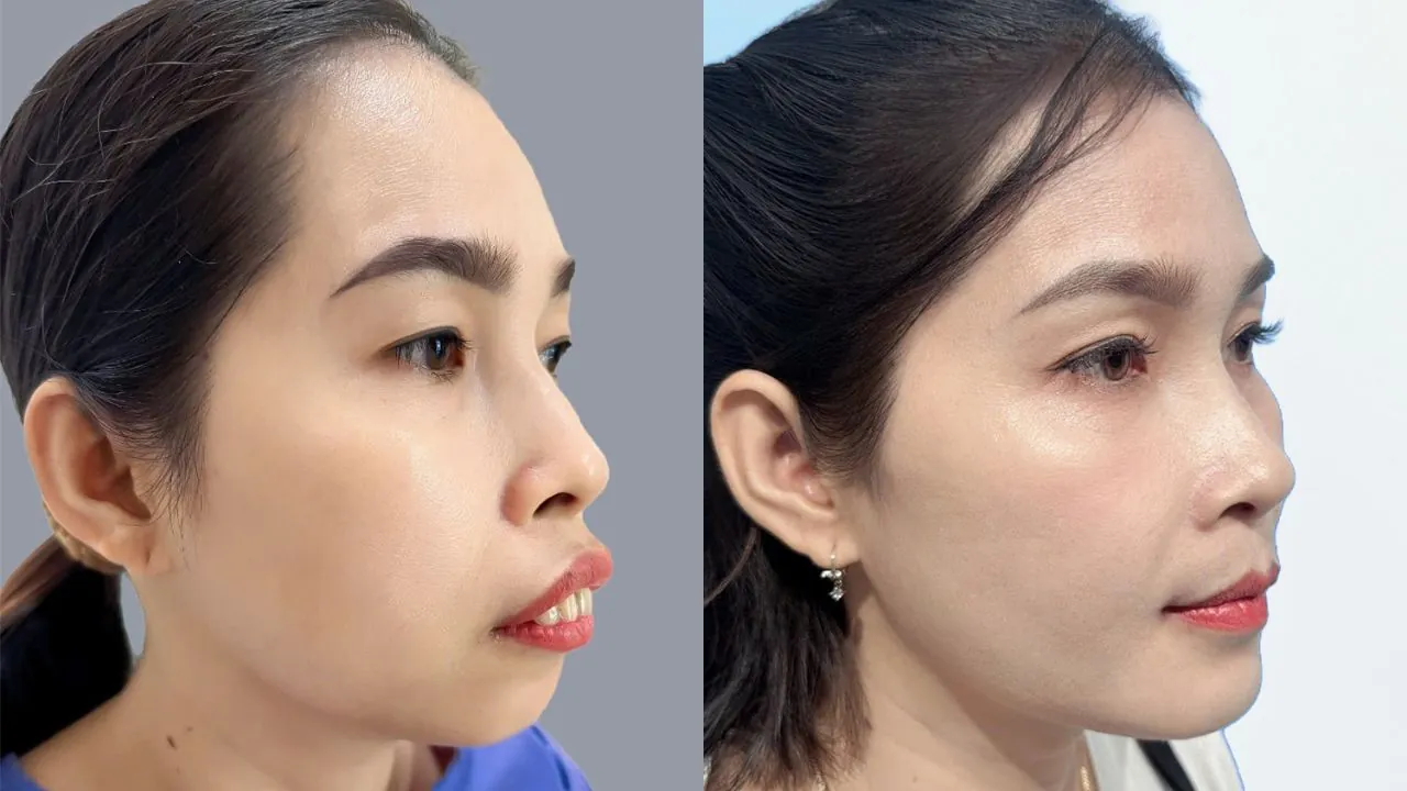 Trần Thị Loan có cằm lẹm, thiếu độ nhô, Sau 30 ngày, cằm có độ nhô rõ hơn, đường nét góc nghiêng cân đối