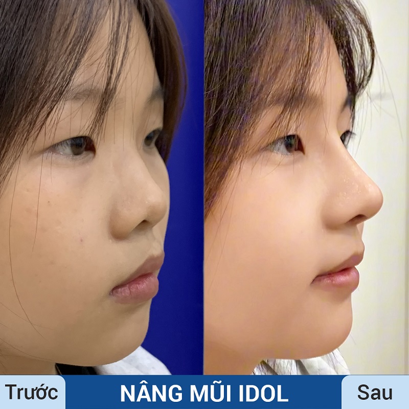 Nên nâng mũi khi đủ tuổi