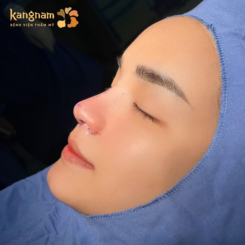 Có thể cắt cánh mũi khi đã đủ điều kiện về tuổi và sức khỏe