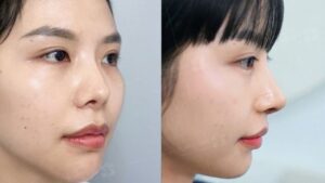 Ai làm được nâng mũi? Điều kiện về độ tuổi và sức khỏe cần biết