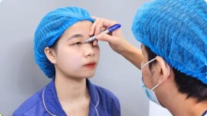 Ai nên cắt mí? 5 trường hợp nên cân nhắc cắt mí