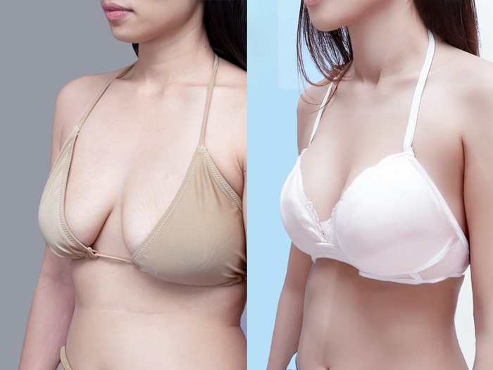 Người ngực trễ có thể nâng ngực