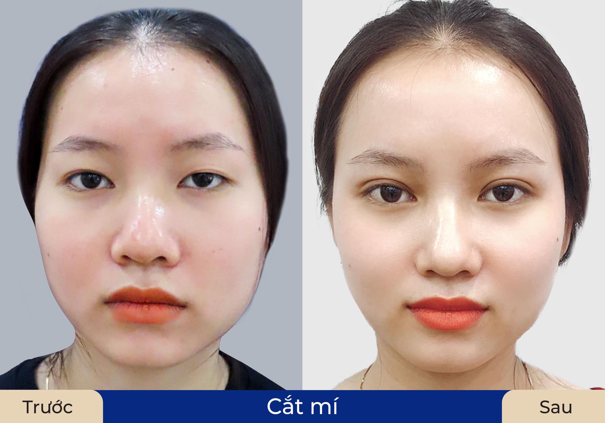 Mắt 2 mí đều đẹp giúp thần thái gương mặt tươi hơn