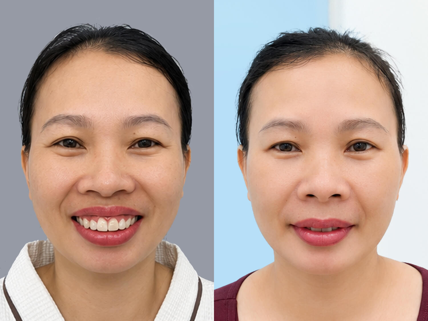 Chị Thanh đã khắc phục được tình trạng hàm hô sau chỉnh hàm tại Kangnam
