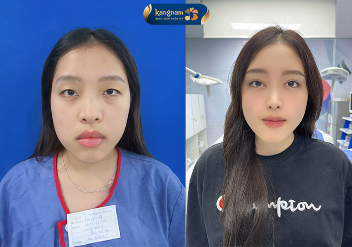 Cắt mí Hàn Quốc Plasma