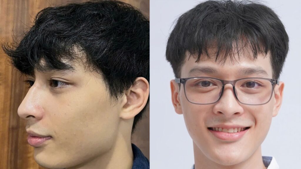 Các phương pháp chỉnh hình hàm mặt : Phân loại, chỉ định & xu hướng