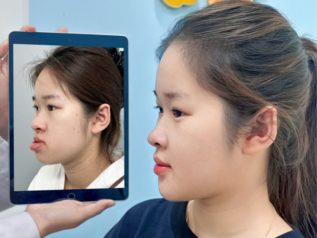 Phẫu thuật chỉnh hàm móm đưa ra trước